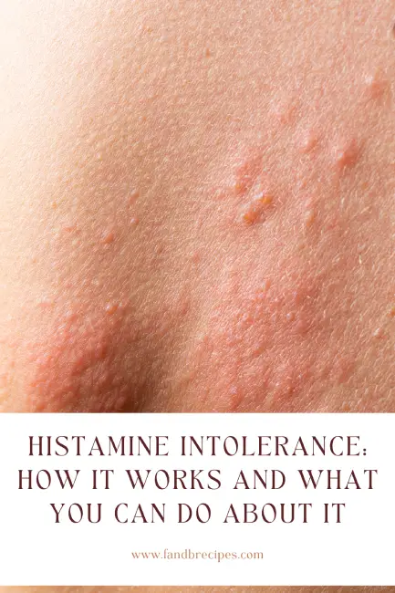 Histamine Intolerance