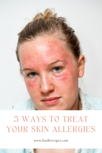 5 Ways To Treat Your Skin Allergies - F and B Recipes