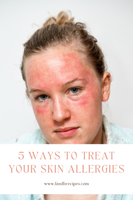 5 Ways To Treat Your Skin Allergies Pin