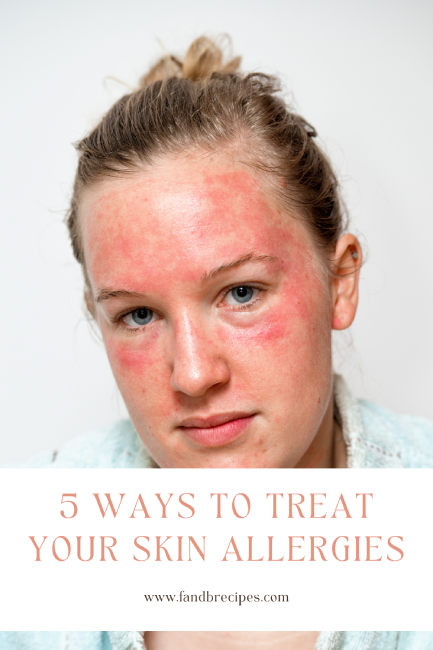 5 Ways To Treat Your Skin Allergies F And B Recipes