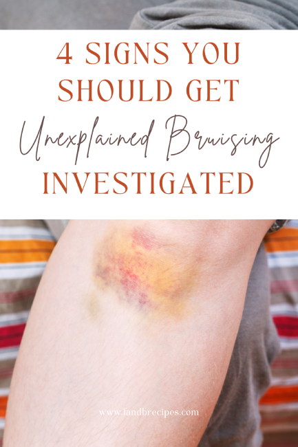 Signs You Should Get Unexplained Bruising Investigated